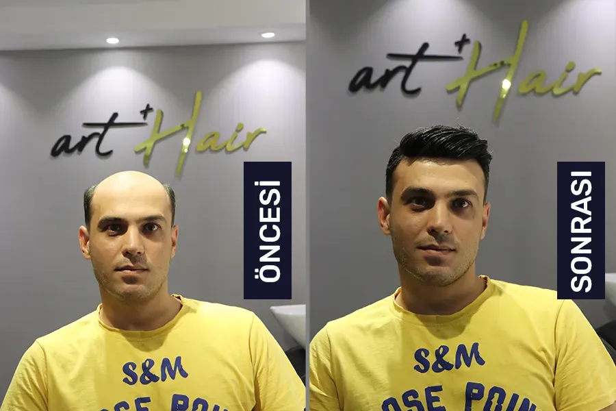 Protez Saç Öncesi Sonrası