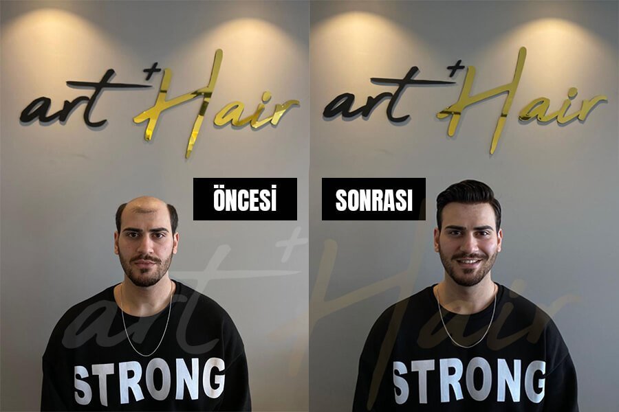 Protez Saçların İşlem Adımları: Uygulama Sürecinden Sonra Nelere Dikkat Edilmeli? - Art Plus Hair İzmir Protez Saç Uygulaması | Öncesi - Sonrası