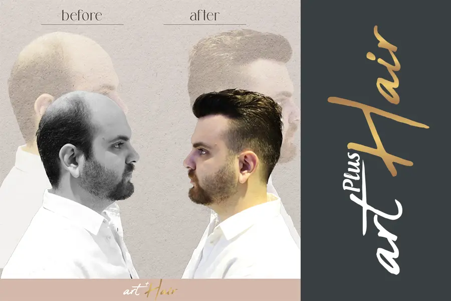 Manisa Protez Saç | Tavsiyesi | Fiyatları - Art Plus Hair Manisa Protez Saç Uygulaması