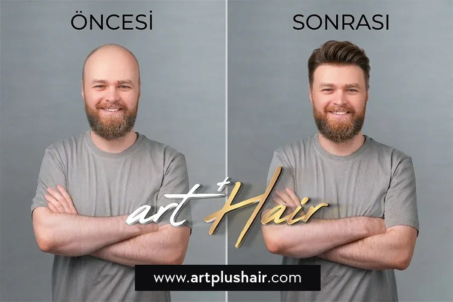 Protez Saç - %100 Doğal İnsan Saçı Gibi - Art Plus Hair Protez Saç Nedir? Tanımı, Anlamı