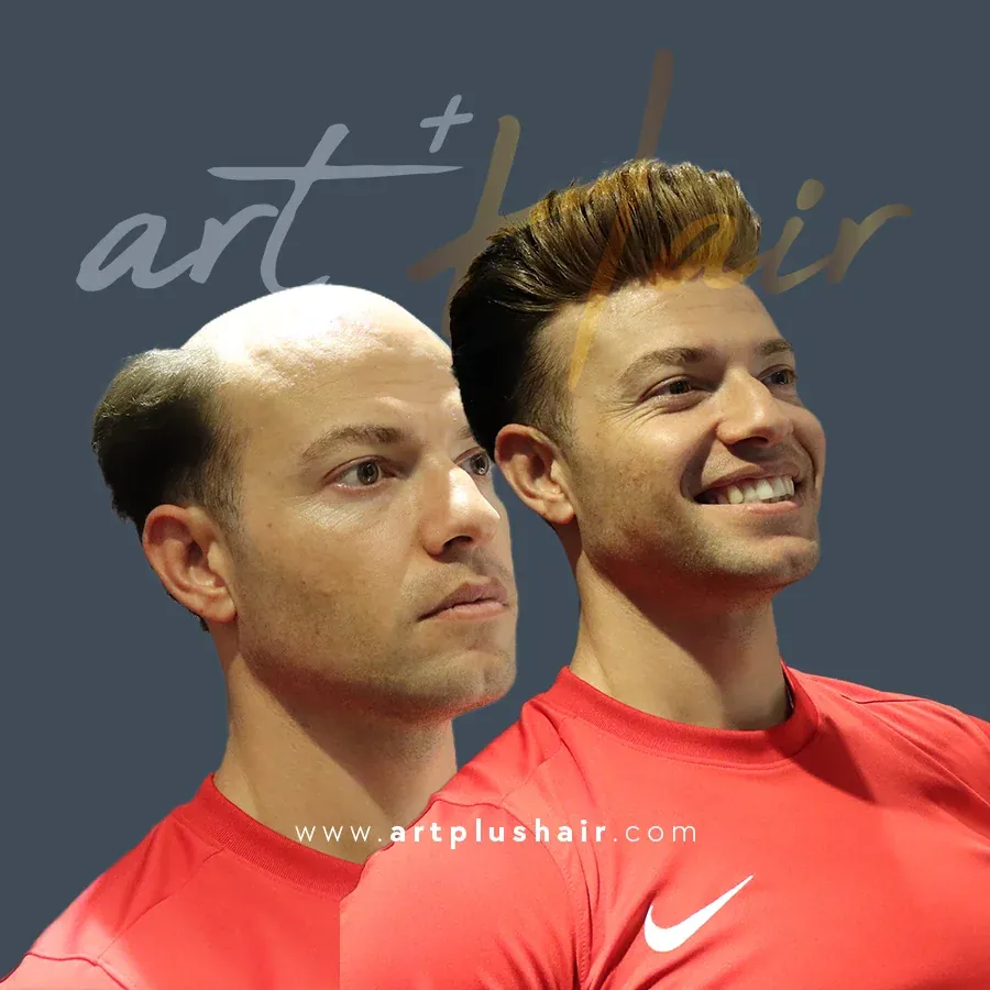 protez sac oncesi sonrasi 7 - Art Plus Hair