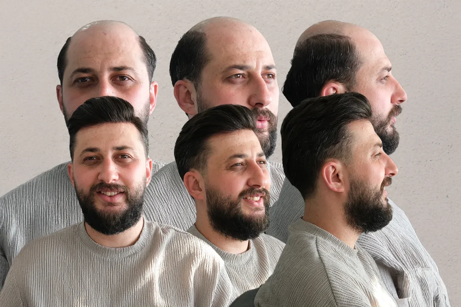 Protez Saç Uygulaması, Öncesi - Sonrası