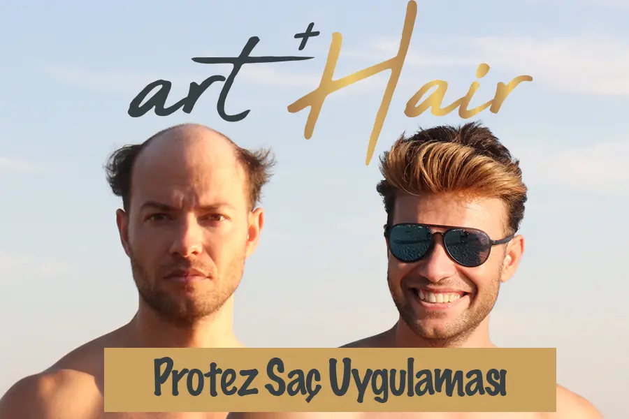 Protez Saç Uygulaması, Faydaları