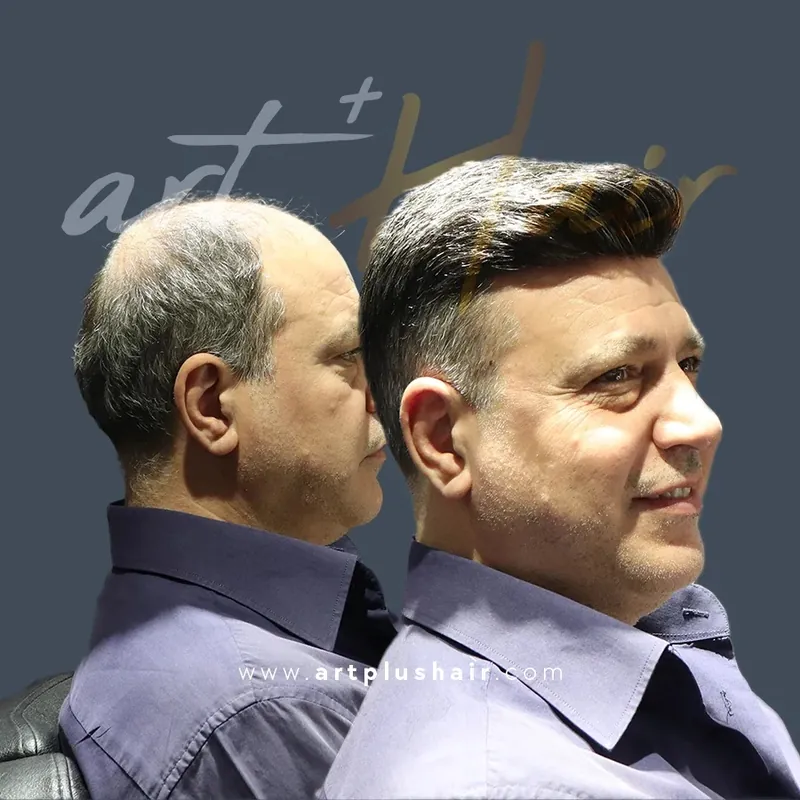 Ön ve tepe bölgesinde saç kaybı olan danışanın protez saç öncesi ve sonrası, yandan görünüm