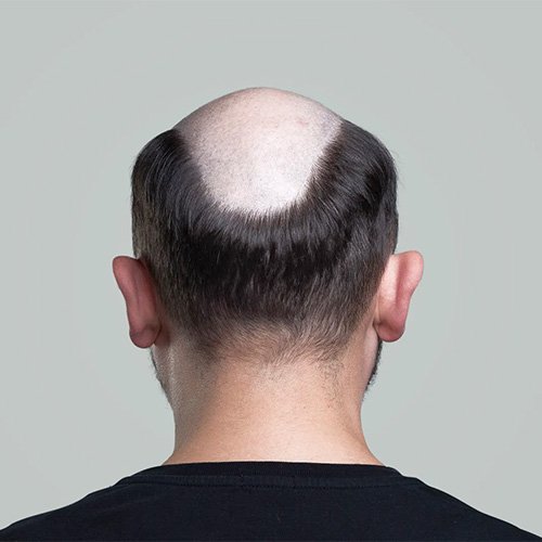 Ana Sayfa - Art Plus Hair Protez Saç Öncesi-4