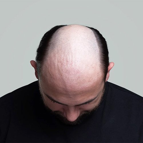 Ana Sayfa - Art Plus Hair Protez Saç Öncesi-2