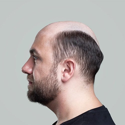 Ana Sayfa - Art Plus Hair Protez Saç Öncesi-3