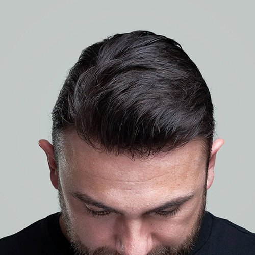 Ana Sayfa - Art Plus Hair Protez Saç Sonrası-3