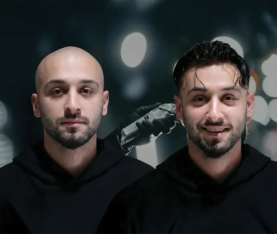 protez saç öncesi - sonrası