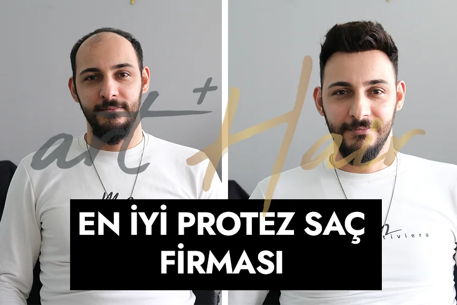 En iyi Protez saç firması | İstanbul'da 1 Numara - Art Plus Hair En İyi Protez Saç Firması - İstanbul