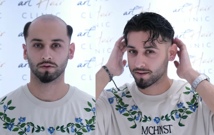 Ana Sayfa - Art Plus Hair İstanbul Protez Saç Önerisi