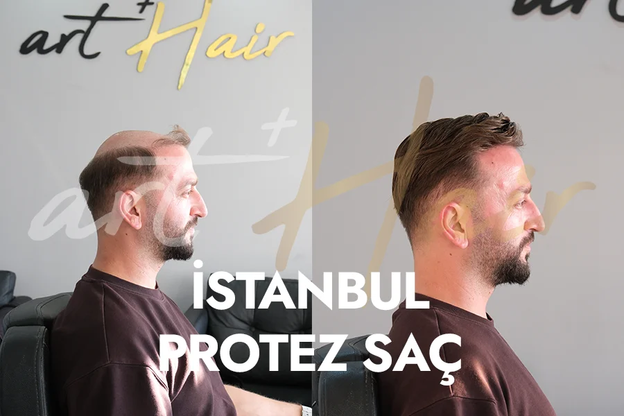 İstanbul’da Protez Saç Seçimi: En Doğal Sonuçlar - Art Plus Hair İstanbul Protez Saç Uygulaması