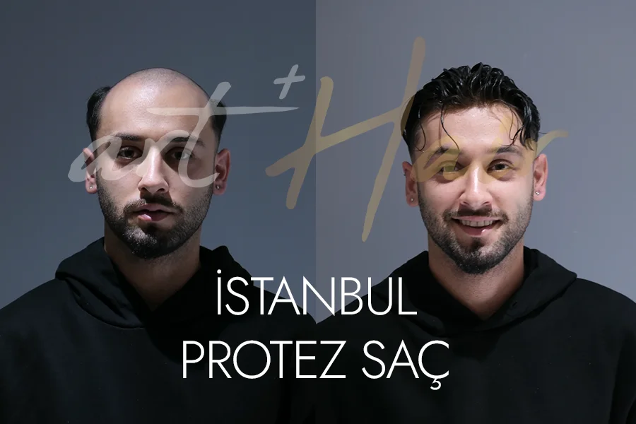 İstanbul’da Protez Saç Seçimi: En Doğal Sonuçlar - Art Plus Hair İstanbul Protez Saç