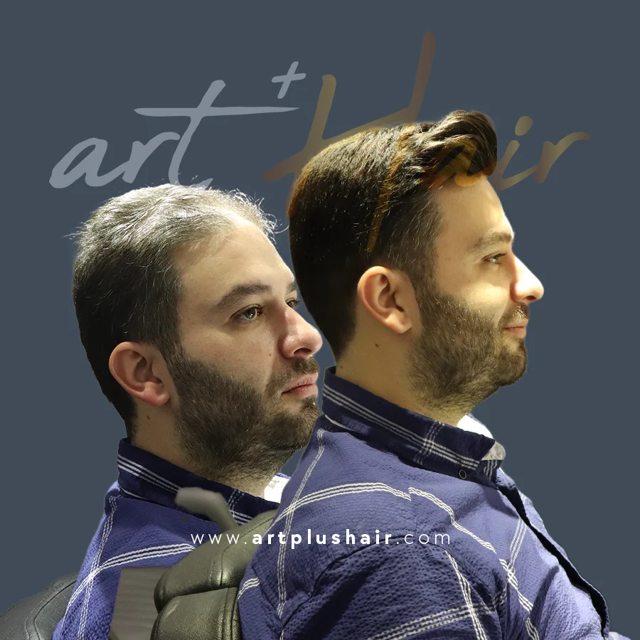 protez sac oncesi sonrasi 10 - Art Plus Hair