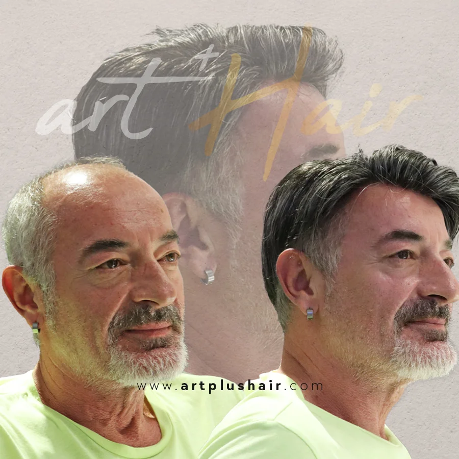 protez sac oncesi sonrasi 12 - Art Plus Hair