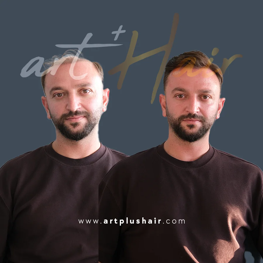 protez sac oncesi sonrasi 2 - Art Plus Hair