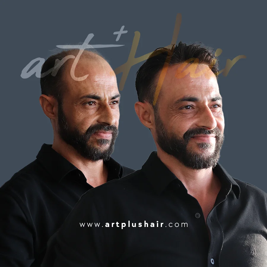 protez sac oncesi sonrasi 4 - Art Plus Hair