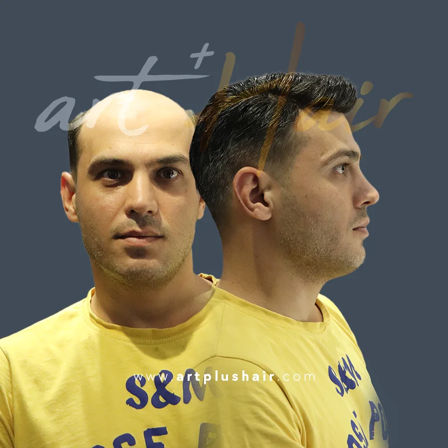 protez sac oncesi sonrasi 5 - Art Plus Hair