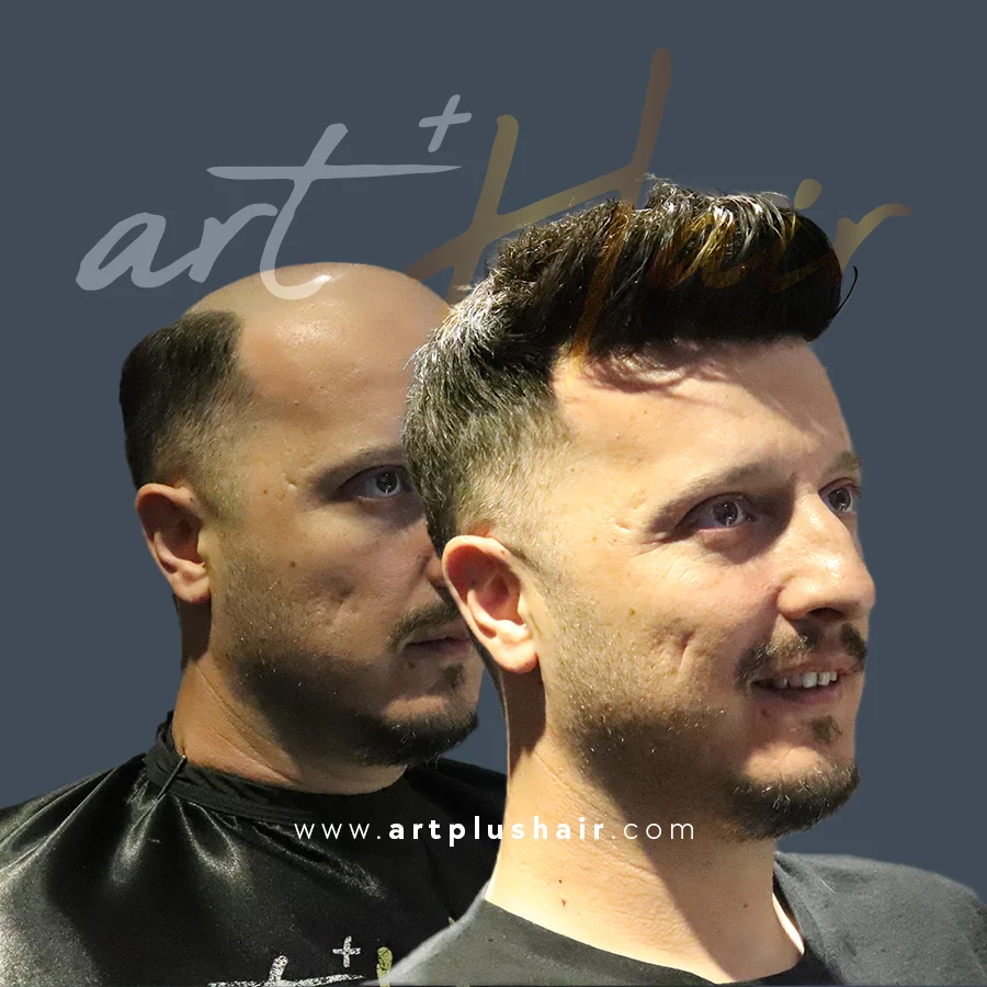 protez sac oncesi sonrasi 6 - Art Plus Hair