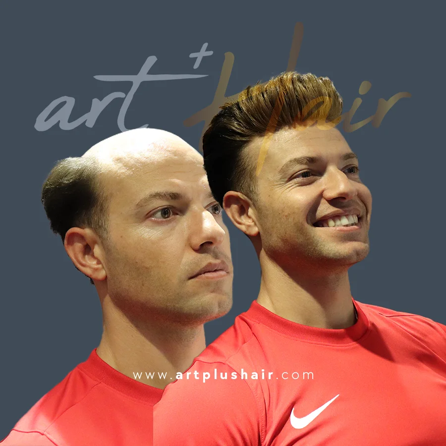 protez sac oncesi sonrasi 7 - Art Plus Hair