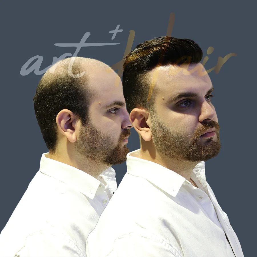 protez sac oncesi sonrasi 8 - Art Plus Hair