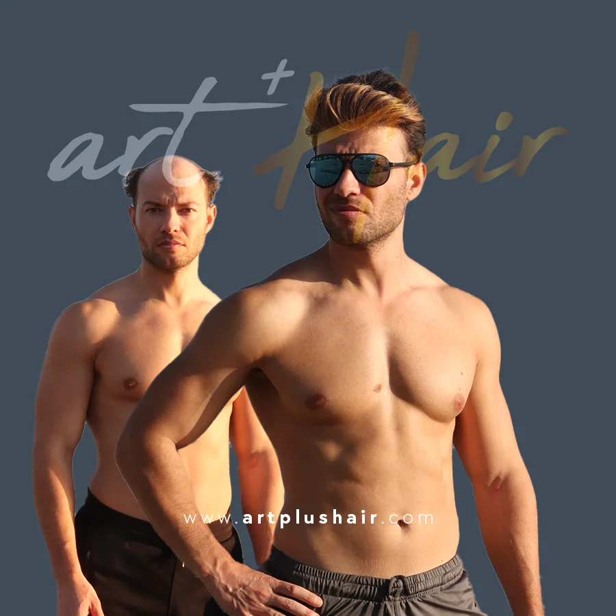 protez sac oncesi sonrasi 9 - Art Plus Hair