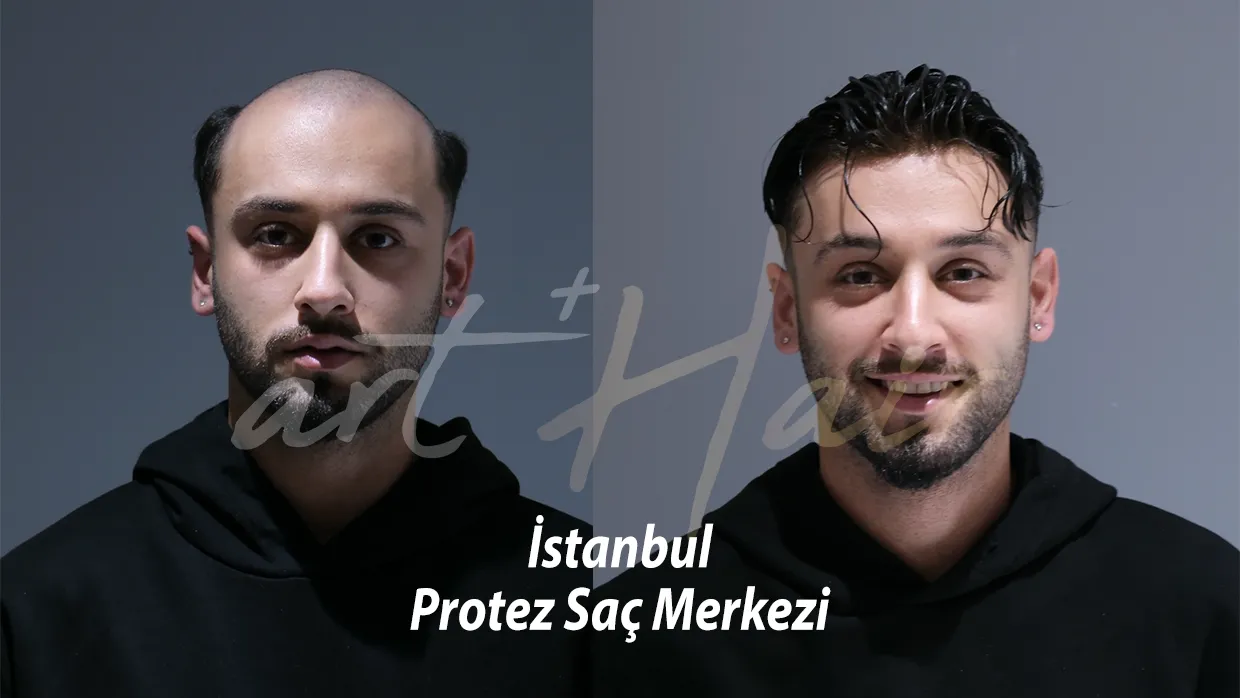 İstanbul Protez Saç Merkezi | %100 İnsan Saçı