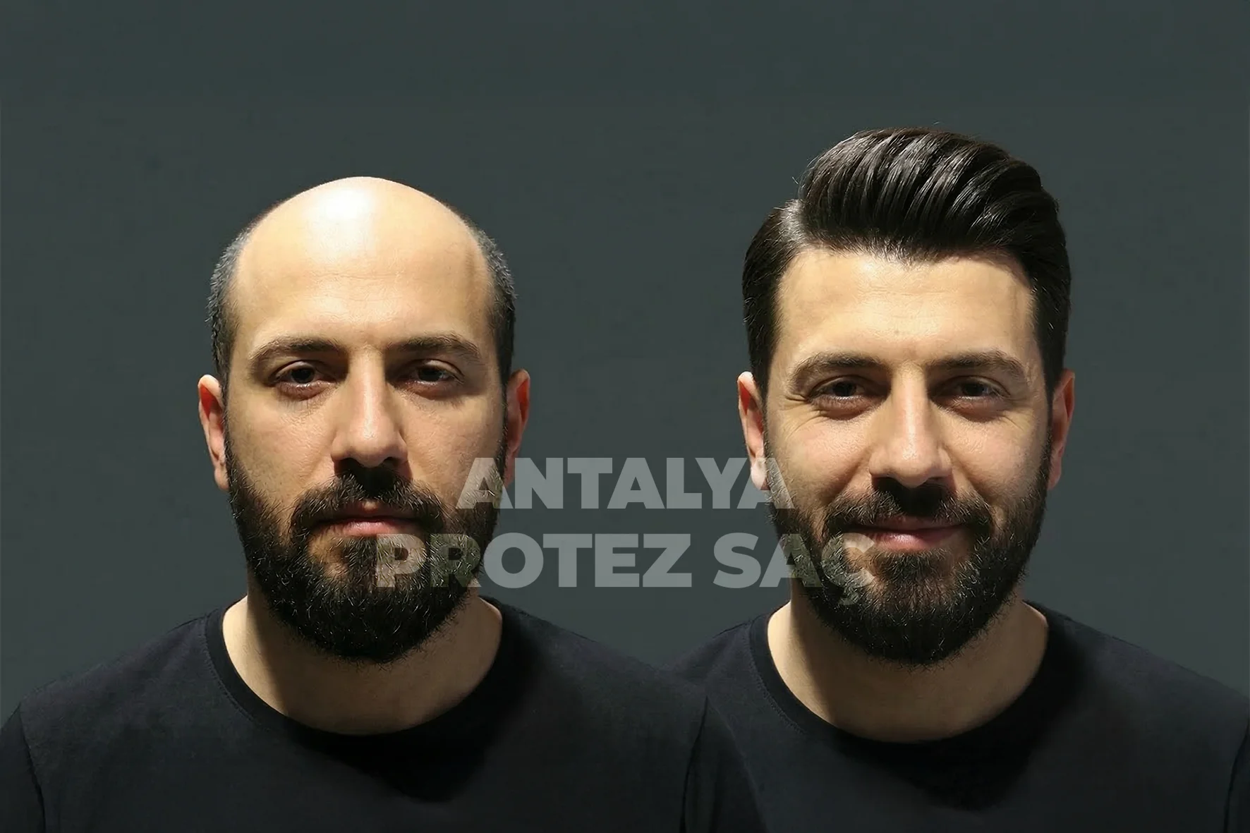 Antalya Protez Saç Merkezi