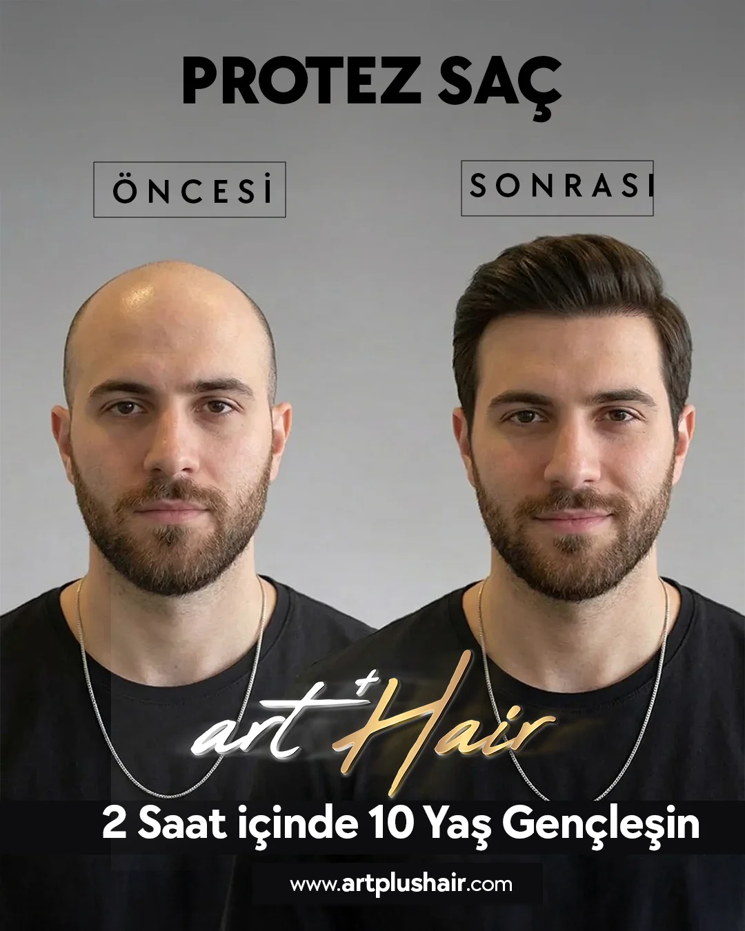 Protez Saç | Öncesi - Sonrası Görünüm